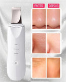 Espátula Ultrassônica de Limpeza Facial – Peeling, Removedor de Cravos e Massageador Facial