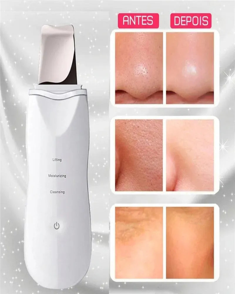 Espátula Ultrassônica de Limpeza Facial – Peeling, Removedor de Cravos e Massageador Facial