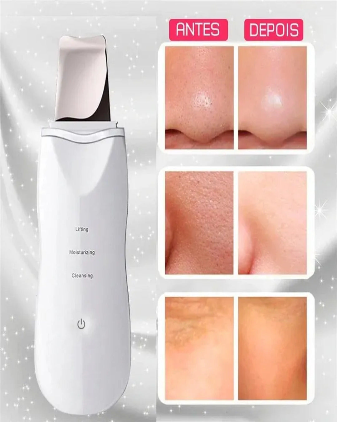Espátula Ultrassônica Facial – Peeling, Limpeza Profunda e Removedor de Cravos
